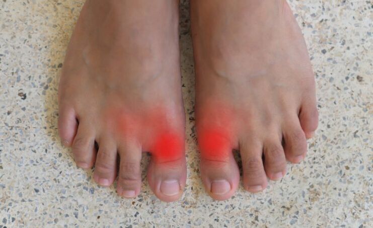 gout big toe pain